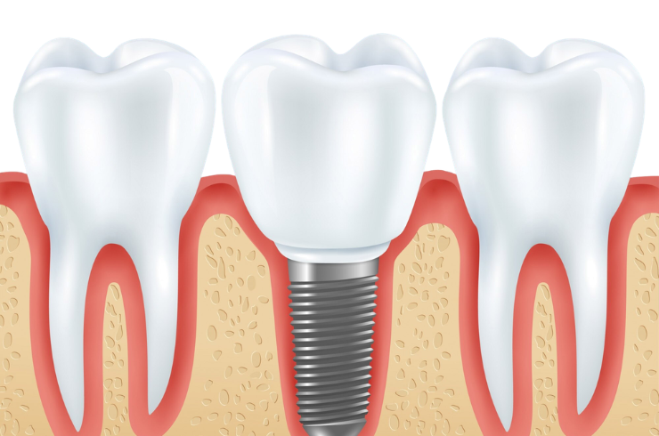 Dental Implants